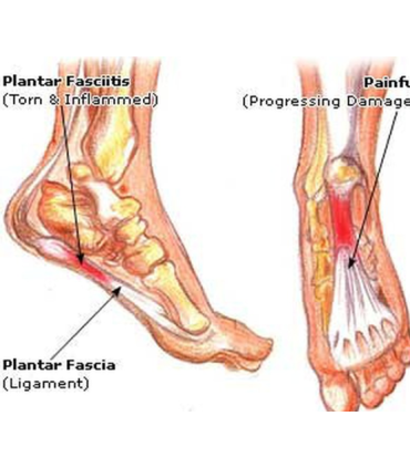 DJO TOBILLERA AIRCAAST AIRHELL PARA FASCITIS PLANTAR TALLA S